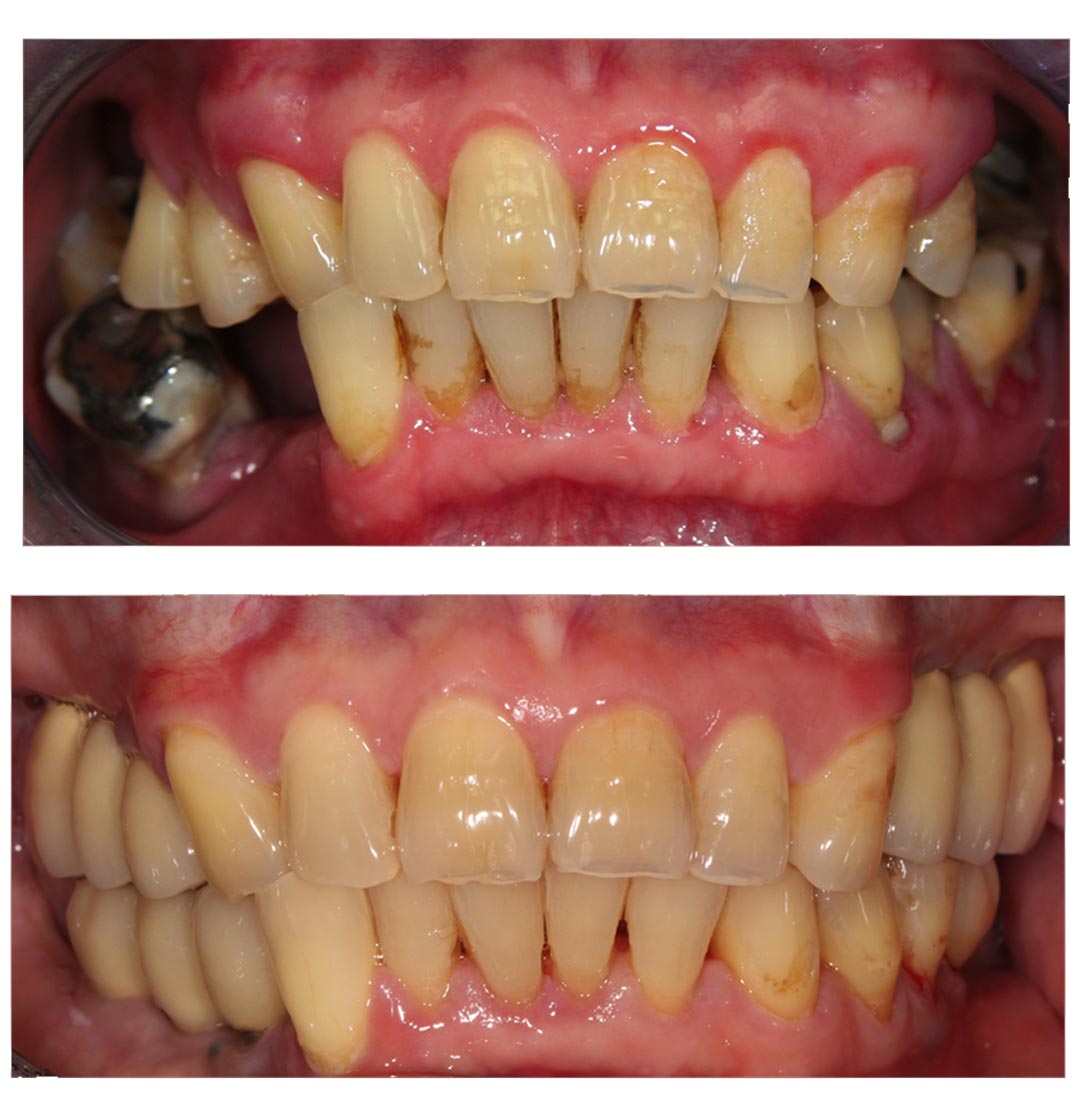 Financial District Same Day Teeth