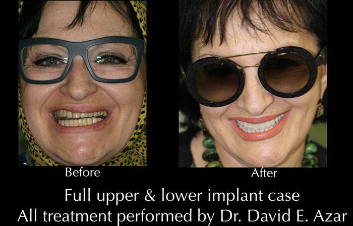 Financial District Veneers