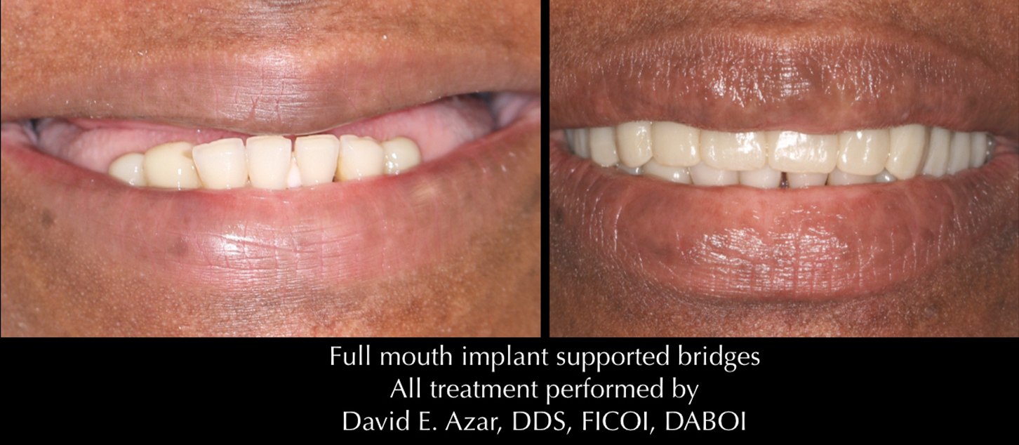 Dental Implants in Financial District