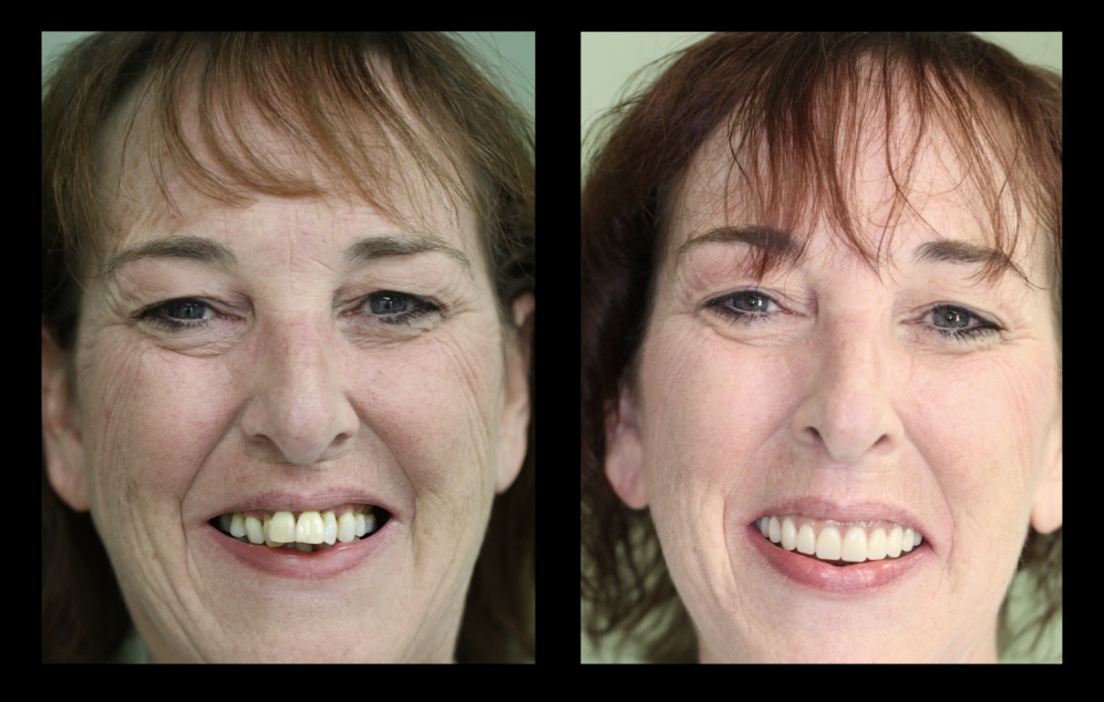 Full mouth implant supported rehab of terminal dentition
