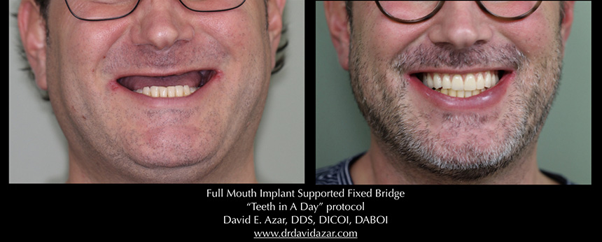 Full mouth implant supported fixed bridge
